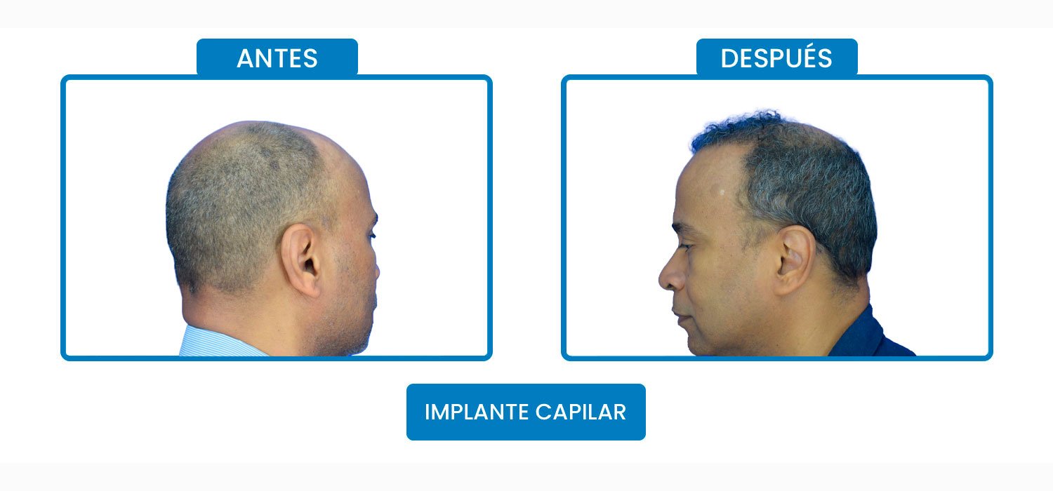 implante-cap-1.jpg