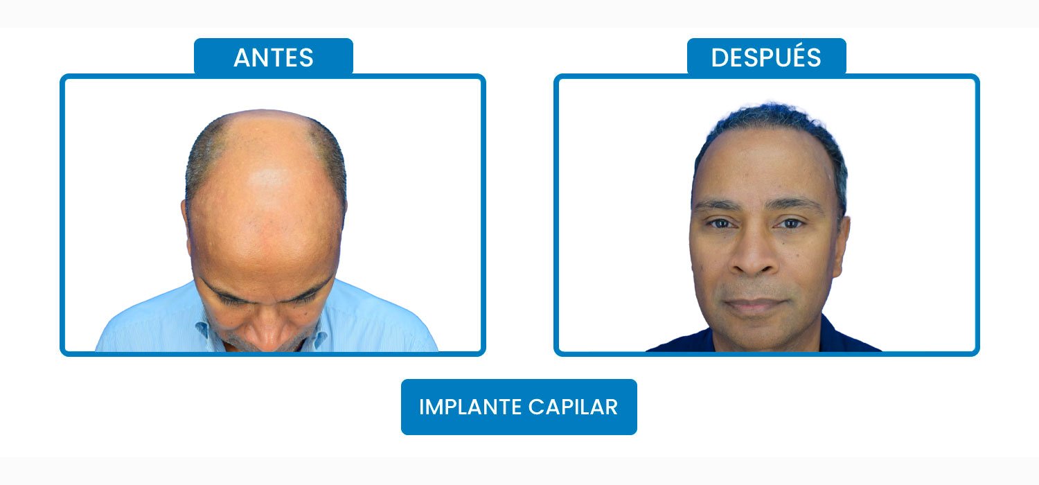 implante-cap-2.jpg